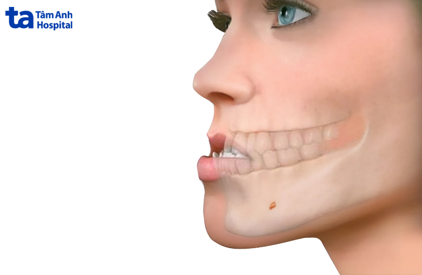 sai khớp cắn loại 3 ảnh hưởng tới chức năng ăn nhai
