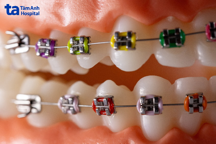 Phương pháp điều trị sai khớp cắn loại 3