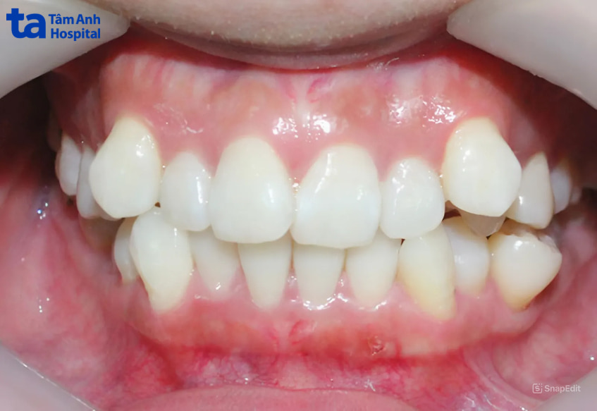 Dấu hiệu sai khớp cắn loại 1