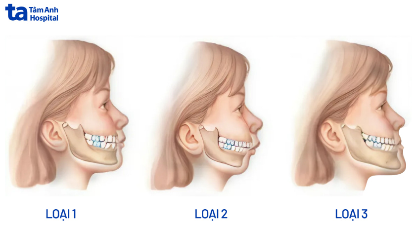 Sai khớp cắn loại 1 là gì?