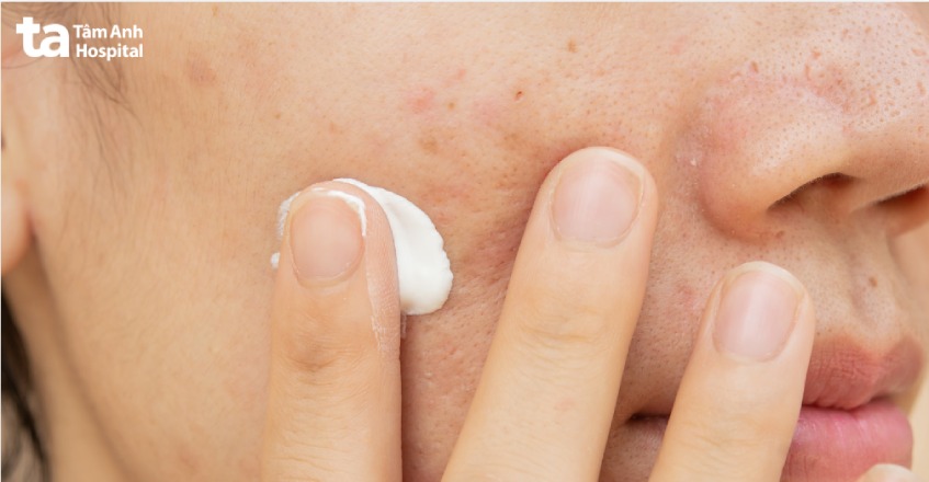 sản phẩm trị sẹo kê đơn theo chỉ định của bác sĩ