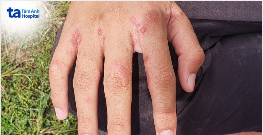 san thương do ghẻ ký sinh ở các kẽ tay chứa đầy ấu trùng
