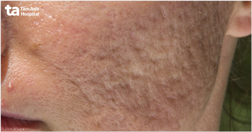 sẹo mụn là dấu vết để lại sau khi mụn biến mất