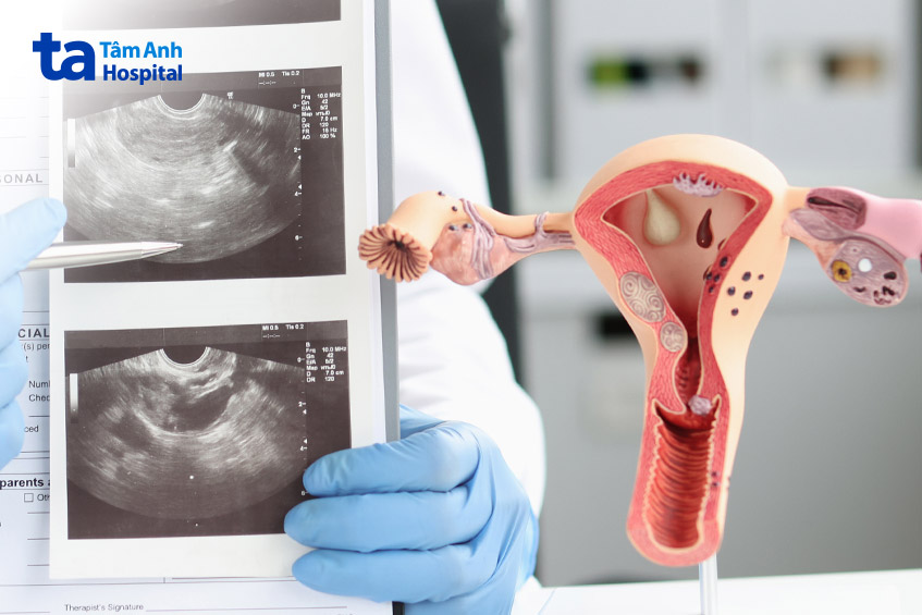 Siêu âm có thể hiển thị mô lạc nội mạc tử cung to và không thể phát hiện nếu kích thước nhỏ