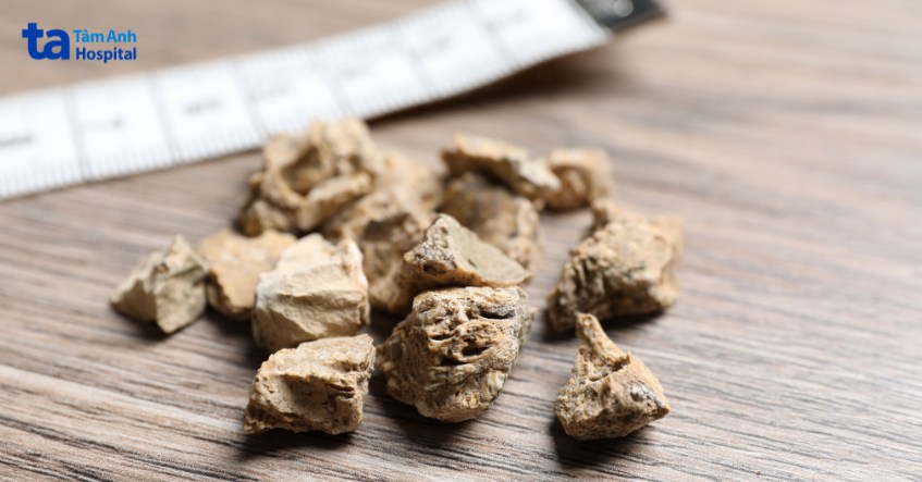 sỏi bàng quang cũng là nguyên nhân