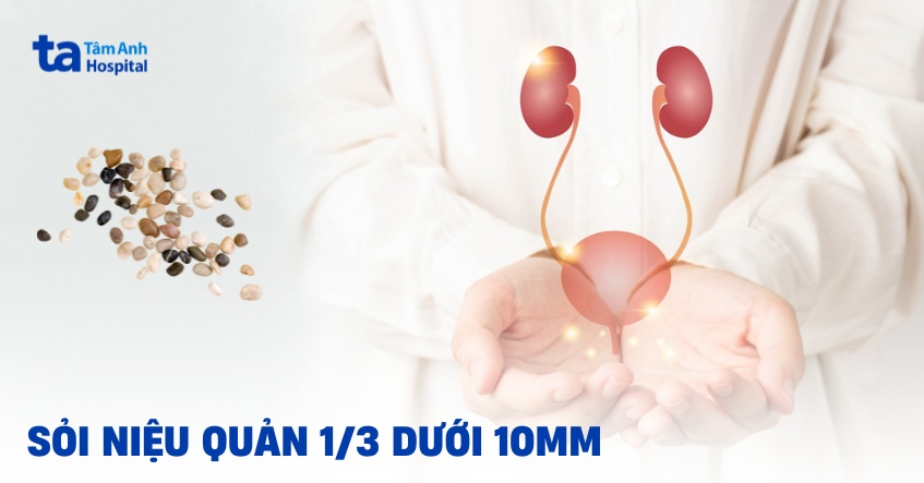 Sỏi niệu quản 1/3 dưới 10mm là gì? Giải pháp điều trị thế nào?