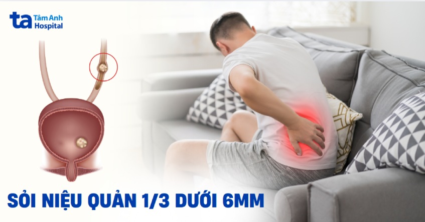 Sỏi niệu quản 1/3 dưới 6mm là gì? Phương pháp trị như thế nào?