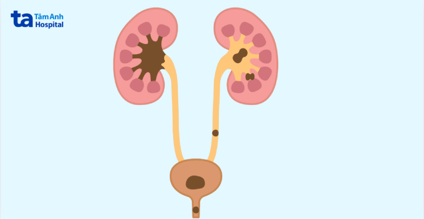 sỏi niệu quản 1 3 dưới hình thành như thế nào