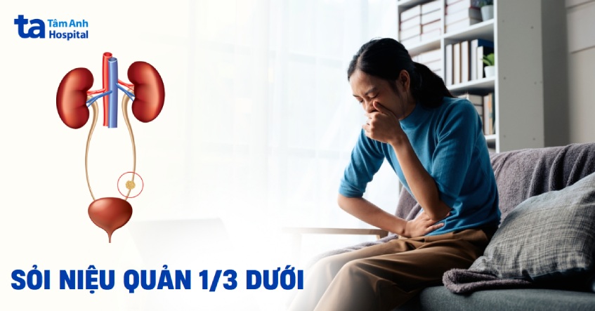 Sỏi niệu quản 1/3 dưới là gì? Triệu chứng và cách điều trị