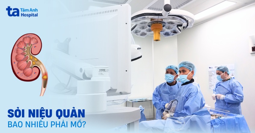 Kích thước sỏi niệu quản bao nhiêu thì phải mổ? Giải đáp chi tiết