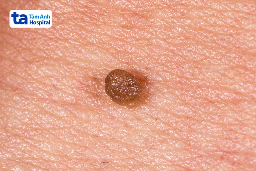 sùi mào gà có thể tái phát