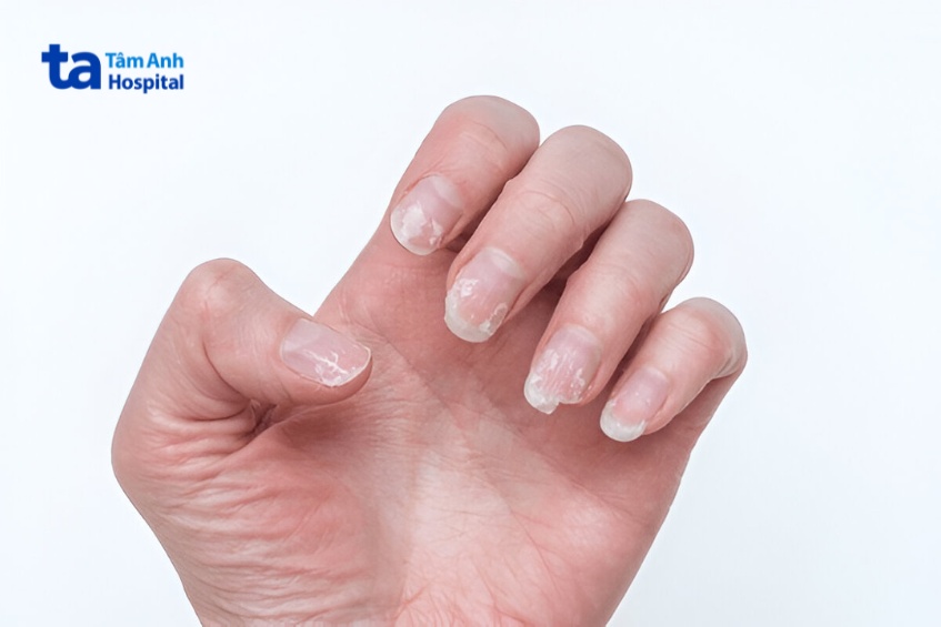 tác hại của nấm kẽ móng tay