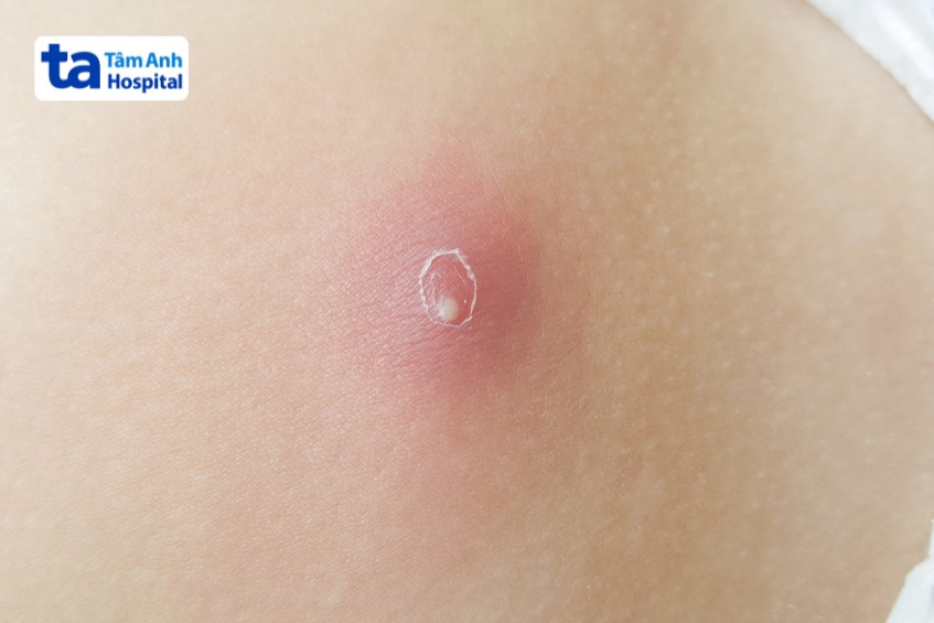 tác nhân gây chủ yếu gây mụn nhọt là tụ cầu khuẩn