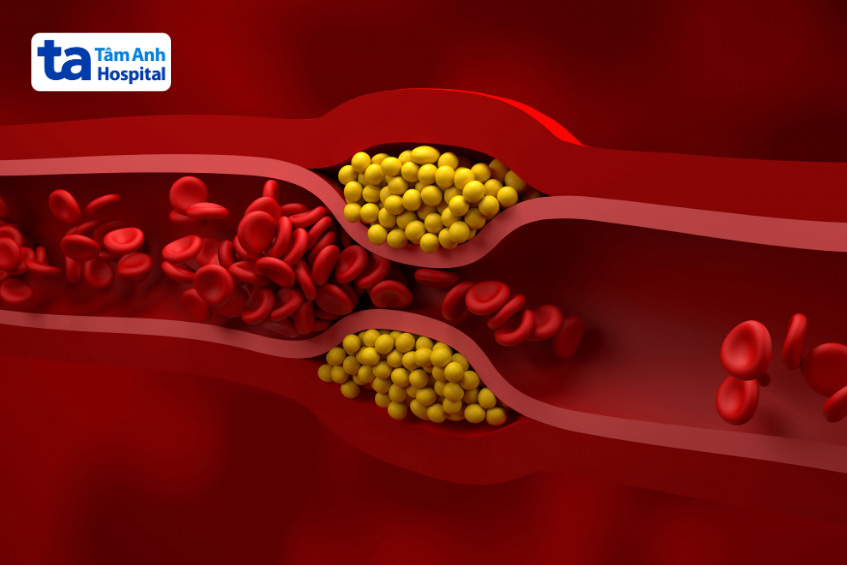 Tăng cholesterol máu gia đình có tính di truyền
