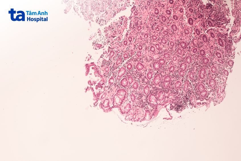 tế bào ung thư đại tràng đã di căn sang buồng trứng