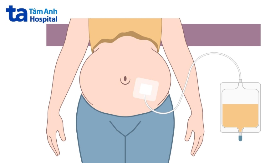 thẩm phân phúc mạc phù hợp với ai