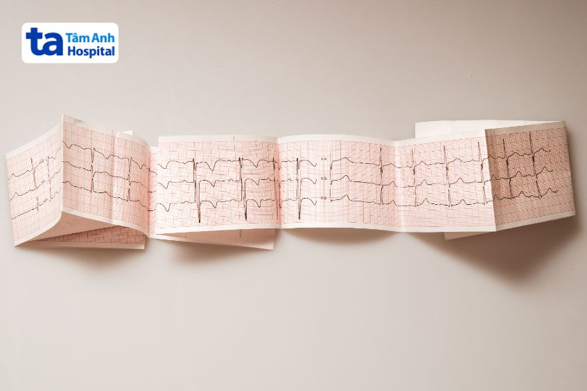 Thiểu sản tâm thất phải có thể gây biến chứng loạn nhịp tim