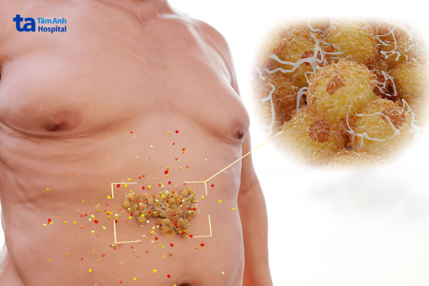 thừa-cân-béo-phì-là-nguyên-nhân-gây-hơn-200-bệnh