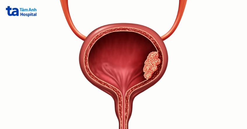 tỉ lệ ung thư bàng quang di tryền