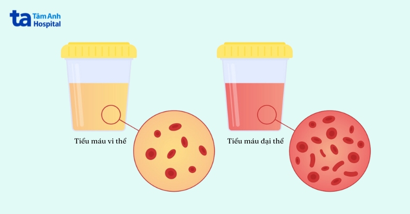 tiểu máu là dấu hiệu ung thư bàng quang