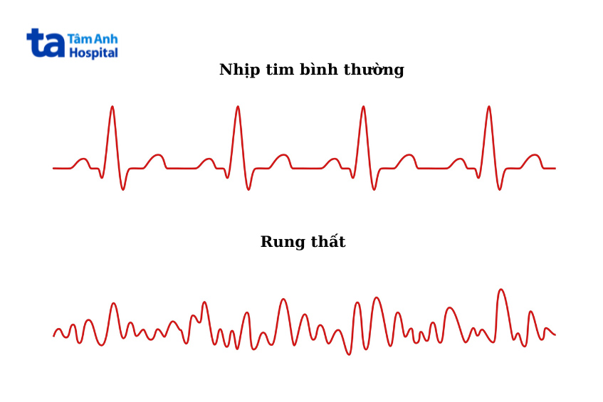 Tín hiệu điện trong tim rối loạn khi bị rung thất