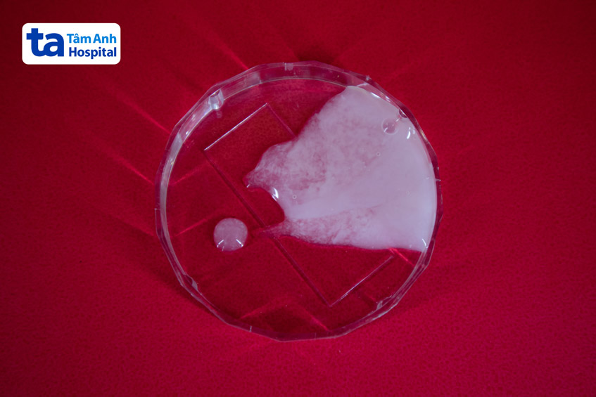 tinh dịch xuất hiện các hạt trắng nhỏ