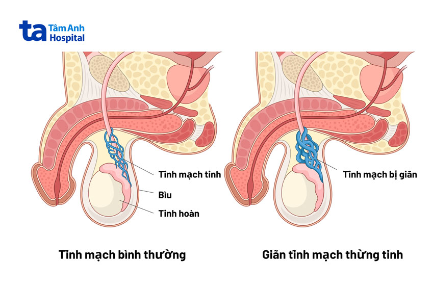 tĩnh mạch bình thường và khi bị giãn