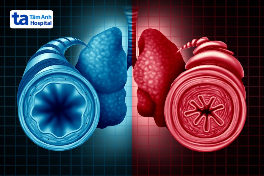 tình trạng hen suyễn và viêm phế quản cấp tính cùng đồng thời xảy ra