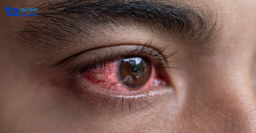 tình trạng khô và đau mắt đỏ