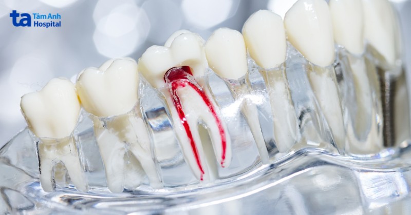 Trám răng lấy tủy là gì?