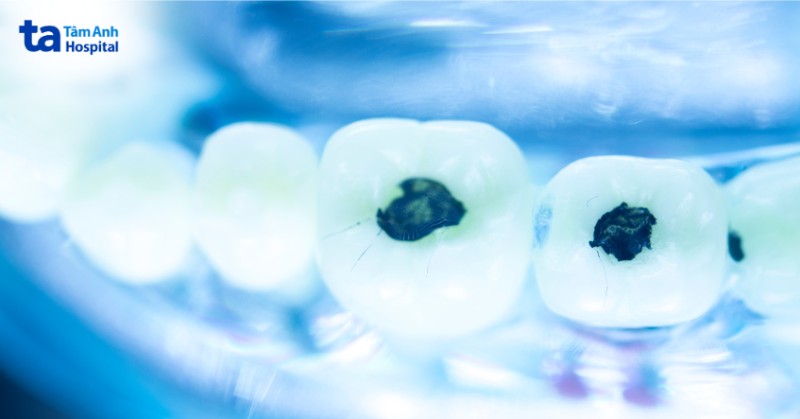 Khi nào trám răng lấy tủy?