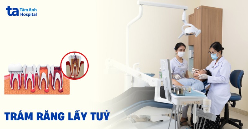 Trám răng lấy tủy là gì? Quy trình như thế nào và các vật liệu