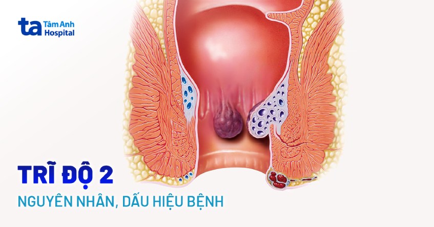 Trĩ độ 2: Nguyên nhân, dấu hiệu nhận biết và phòng ngừa