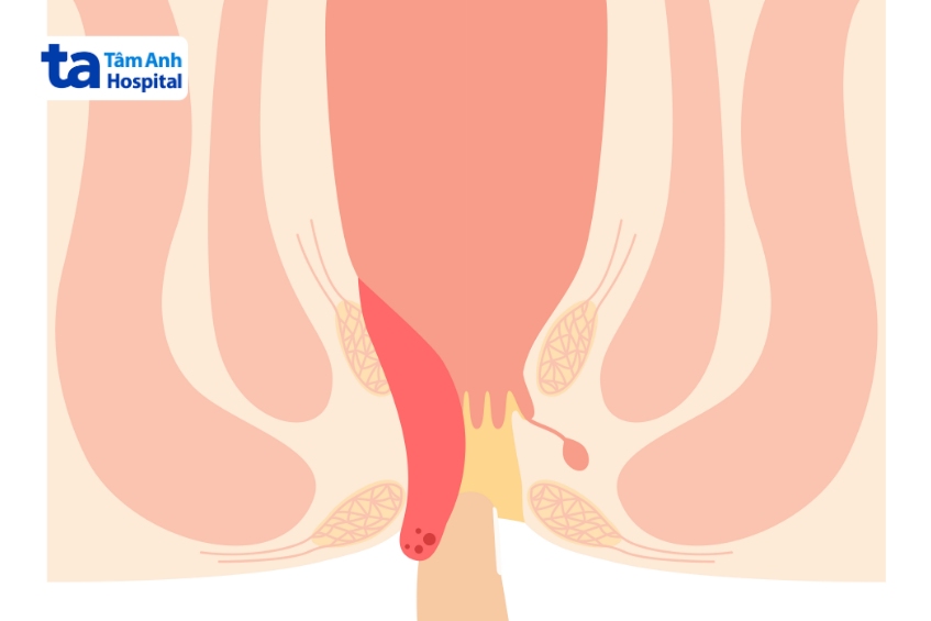 trĩ sa có nguy hiểm không