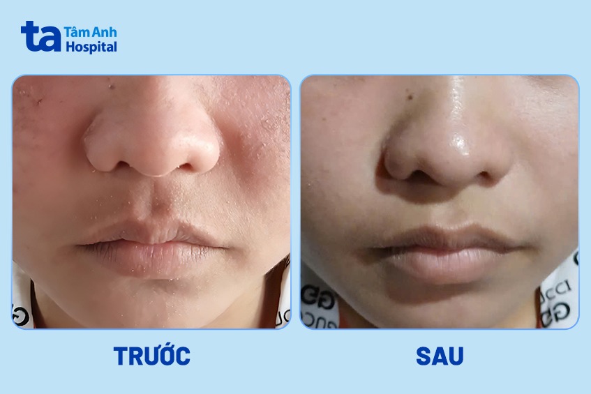 trước và sau điều trị