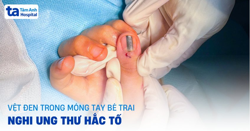tưởng ung thư hóa nốt ruồi lành tính