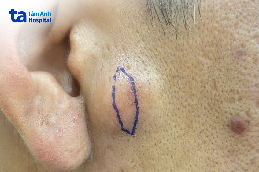 u bã đậu trước phẫu thuật