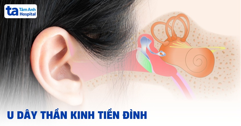 U dây thần kinh tiền đình: Triệu chứng, nguyên nhân, cách điều trị