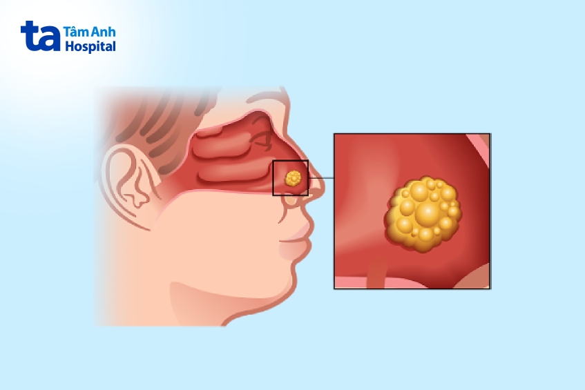 u hốc mũi ảnh hưởng gì