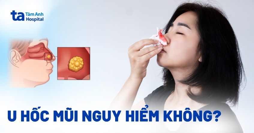 U hốc mũi có nguy hiểm không? Biến chứng thường gặp