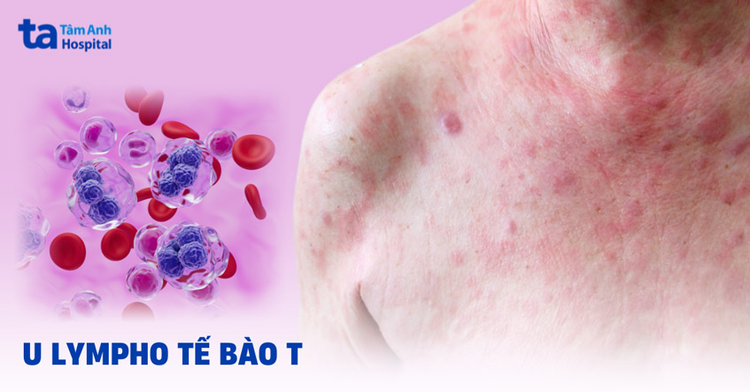u-lympho-tế-bào-t