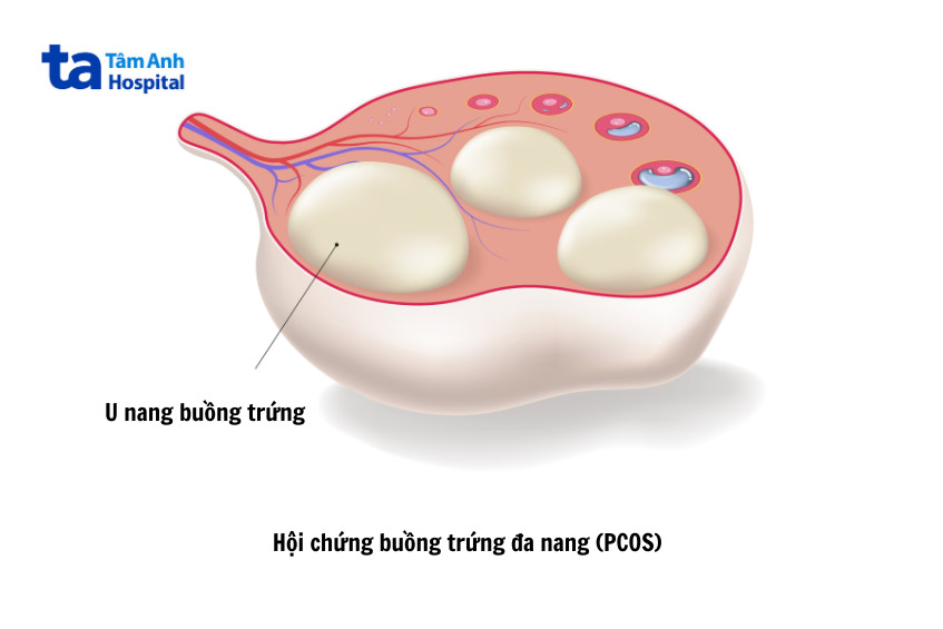u nang ở buồng trứng