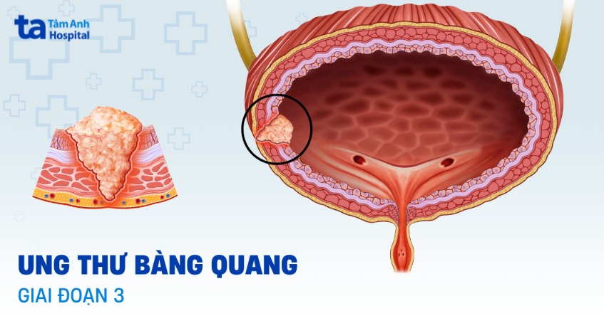 Ung thư bàng quang giai đoạn 3: Triệu chứng, tiên lượng, điều trị