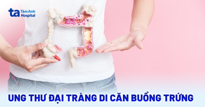 Ung thư đại tràng di căn buồng trứng: Dấu hiệu và cách điều trị