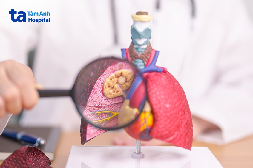 ung thư màng phổi không được can thiệp sẽ tiếp tục di căn