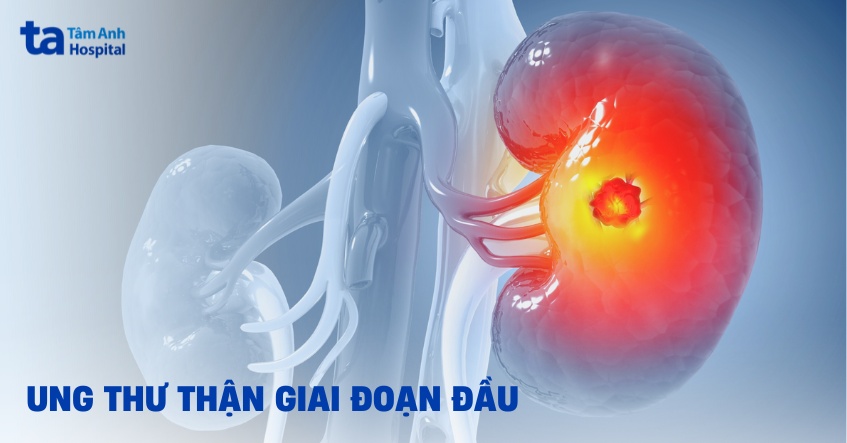 Ung thư thận giai đoạn đầu: Dấu hiệu, chẩn đoán và cách điều trị