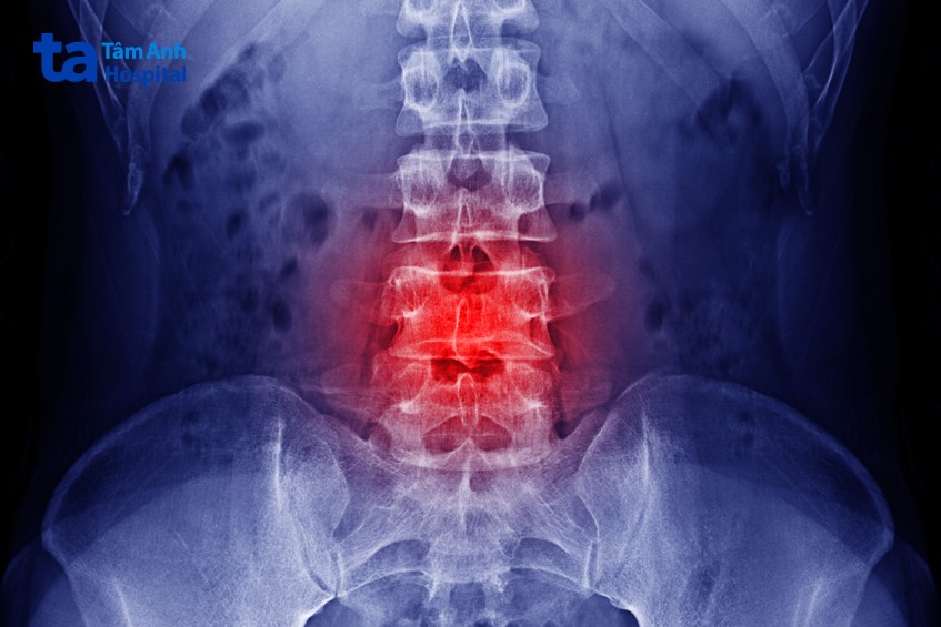 ung thư trực tràng di căn đến xương