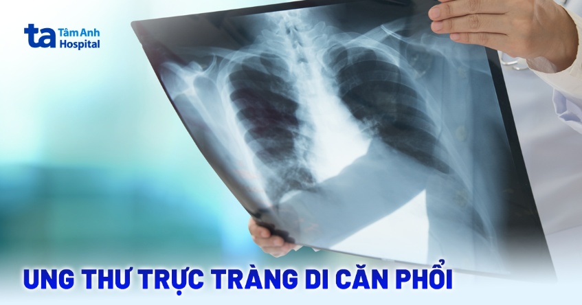 Ung thư trực tràng di căn phổi: Triệu chứng, chẩn đoán, điều trị