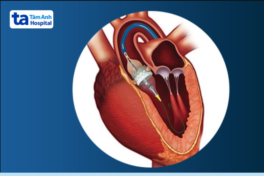 Van động mạch chủ bị tổn thương sẽ được thay thế bằng van nhân tạo và hoạt động như bình thường