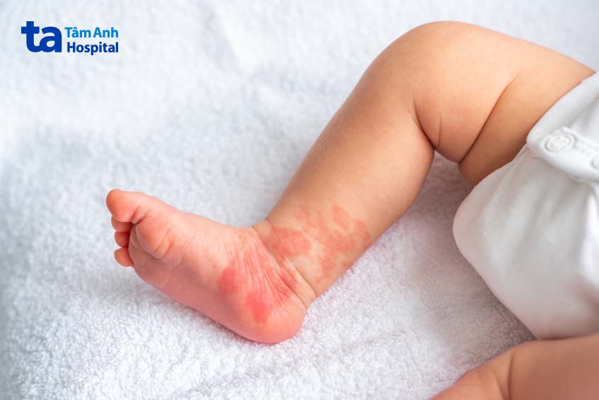 Vết bớt rượu vang ở trẻ sơ sinh ở chân